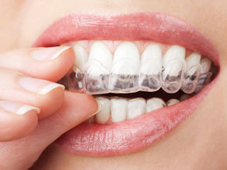 hand holding clear teeth aligners in mouth, Beverly Grove, Los Angeles, CA Invisalign, Beverly Hills, CA Invisalign treatment